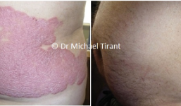 Nghiên cứu mở đa trung tâm về sản phẩm Dr Michaels thảo dược điều trị vảy nến